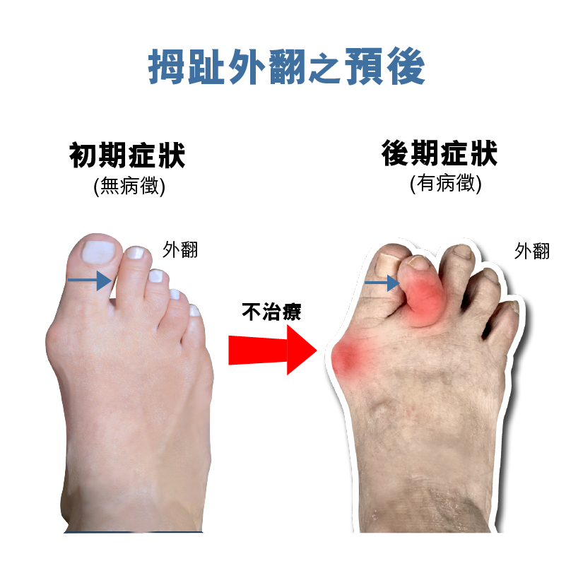 F04b - 拇趾外翻拉繩矯形器(左邊)