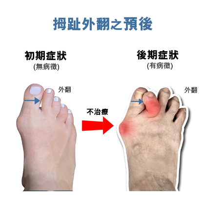 F04b - 拇趾外翻拉繩矯形器（左邊）